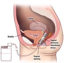 What Is Electrical Stimulation And Is It A Solution For Female Incontinence Medicalopedia