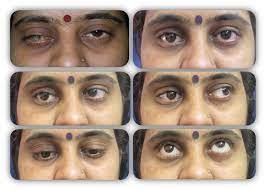 Prosthetic Eye Service Axis Eye Clinic