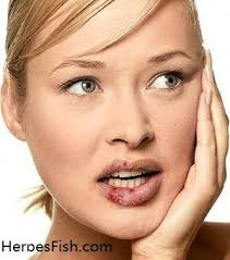 One of the most striking is the appearance of clean linear erosions. Pin On Herpes Photos On Women