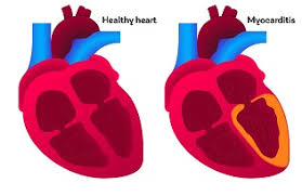 Myocarditis definition myocarditis is an inflammatory disease of the heart muscle (myocardium) that can result from a variety of causes. Myocarditis Causes Symptoms Treatments British Heart Foundation