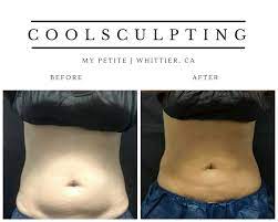 You will have to pay for these repeated treatments just as you paid for the first treatment. Coolsculpting Fat Freezing Your Ultimate Guide