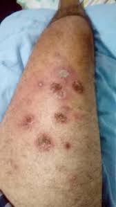 Image result for Pathergy