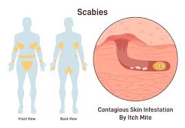 Image result for scabies transmission