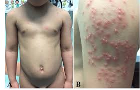 Image result for Varicella zoster on human skin