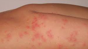A chlorine rash is typically found as a rash on a person after he/she has been exposed to chlorine. Chlorine Rash Treatment And Prevention