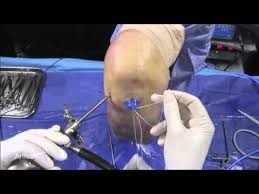 What this means is a simple removal of the torn portion. Horizontal Meniscal Tear Repair Using The Knee Scorpion Suture Passer Youtube
