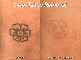 It is based on natural methods that regenerate on one's natural skin. Laser Tattoo Removal Mobile Alabama The Martin Center Mobile Alabama