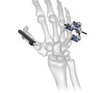 Acumed Mini External Fixation System