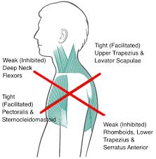 Upper Crossed Syndrome A Chiropractor S Guide To Postural Pain