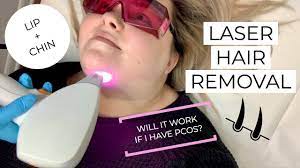 I Got Laser Hair Removal On My Lip And Chin Pcos Spaderma Chicago Youtube