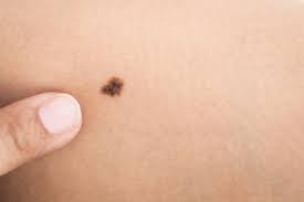 Melanoma research alliance is a leading funder of melanoma research, committed to accelerating scientific discovery and the development of new treatments and diagnostics for this deadly skin cancer. Hautkrebs Schwarz Malignes Melanom Citypraxen Berlin