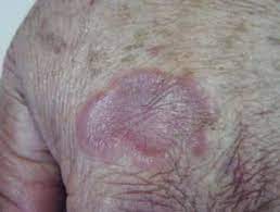 Scielo Brasil Leprosy Review Of The Epidemiological Clinical And Etiopathogenic Aspects Part 1 Leprosy Review Of The Epidemiological Clinical And Etiopathogenic Aspects Part 1