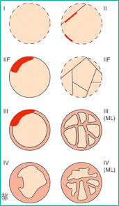 simple and complex renal cysts in adults classification