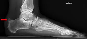 Haglund syndrome refers to the triad (haglund triad) of: Schmerzen Am Achillessehnenansatz Hirslanden Blog