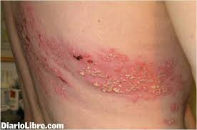 Diario Libre Vacuna Del Herpes Zoster Aqui Los Sintomas Y Como Se Transmite La Enfermedad Conocida Como Culebrilla Ht Ly C4c7d Facebook