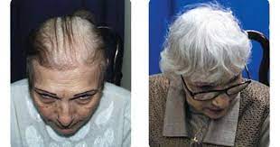 صور استعادة الشعر للنساء عيادة كوزمسيرج لزراعة الشعر في دبي