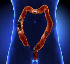 These cancers may be fatal if not treated early. The 10 Most Fatal Cancers For Men