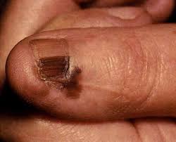Image result for Acral lentiginous melanoma nail