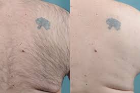 Search for other hair removal in south richmond hill on the real yellow pages®. Hair Removal Robotic Restoration