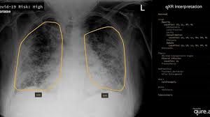 Individuals may appear in more than one. The Groundbreaking Way To Search Lungs For Signs Of Covid 19 Bbc News