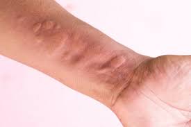 Dalam terma perubatan, gegata dikenali sebagai urticaria. Tujuh Penyebab Kulit Gatal Angkara Gegata Life With Love