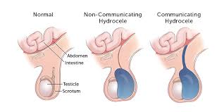 The problem is that the warning signs for many kinds of cancer can seem pretty mild. Hydrocele Boston Children S Hospital