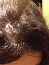 Androgenic alopecia (male pattern baldness) is well studied, and its mechanism is not based on scalp environment. Breast Cancer Topic Peeling Tender Scalp From Cold Caps