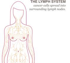 Breast cancer happens when cells stop working correctly, creating abnormal cells that grow uncontrollably. Lymph Node Removal Lymphedema National Breast Cancer Foundation