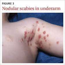 Image result for scabies in the groin area