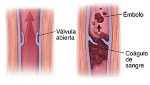 Maybe you would like to learn more about one of these? En Que Consiste La Trombosis Venosa Profunda