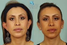 Chavez are plastic surgeons specializing in cosmetic plastic surgery. El Paso Cosmetic Surgery Otoplasty Or Ear Pinning Is A Surgical Procedure Used To Correct Pronounced Deformities Of The Ear Such As Problems With Protruding Ears Starting Price Is 2800 915 800 3779 Facebook