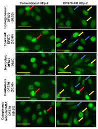 Simultaneous Distinction Of Monospecific And Mixed Dfs70 Patterns During Ana Screening With A Novel Hep 2 Elite Dfs70 Knockout Substrate Protocol Translated To German