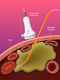 Image result for Liver Abscess