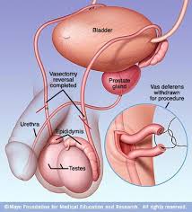A vasectomia é reversível, mas como veremos adiante, o sucesso do procedimento de reversão não é garantido. O Que E Uma Vasectomia Health Life Media