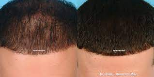 When transferring your own platelet rich plasma into balding areas of the scalp, a regenerative process occurs within the hair follicles. Vampire Prp Treatment For Hair Loss Bauman Medical
