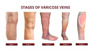 Varicose veins can happen anywhere in the body, but are more common in the legs. What Are Varicose Veins Symptoms Causes Treatment Procedures