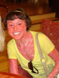 Harlequin ichthyosis (hi) is the most severe phenotype of the autosomal recessive congenital ichthyoses. 9 Uncommon Skin Conditions Cbs News