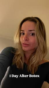 Patience is key! ⏳ Botox can take 3 to 7 days to start working and up to 2  weeks for full results. Don’t worry if you don’t see an immediate  change—your smooth, refreshed look is