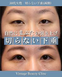 眼瞼 下垂 30 代