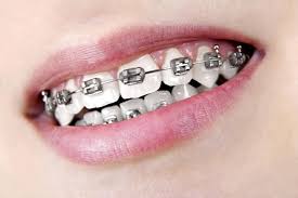 Black And White Braces Braces And White Spots On My Teeth Braces Colors Teeth Braces Metal Braces