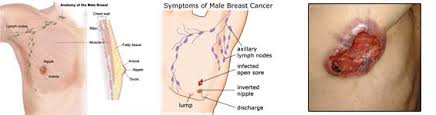 For every 100 women who develop breast cancer in the us, one male is diagnosed with the equivalent disease. Male Breast Cancer Male Awareness Foundation