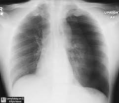 This buildup of air puts pressure on the lung, so it cannot expand Learningradiology Tension Pneumothorax Ptx Spontaneous Shift Imaging