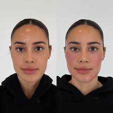 INTRODUCING: REJURAN REJURAN is a New Concept Bio-Regenerator (you know we  love all things regenerative medicine) made of polynucleotides, which are  DNA fragments of a specific size derived from wild salmon. These