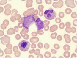 What Are Myelodysplastic Syndromes