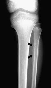 Image result for periostitis