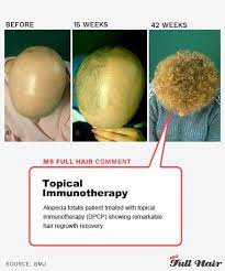 Pin On Hair Loss Remedies Treatments