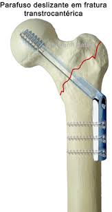 Resultado de imagem para fraturas radiologia