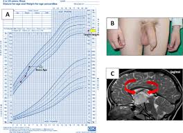 Image result for Precocious Puberty
