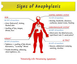Image result for Anaphylaxis
