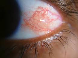 Image result for Scleritis